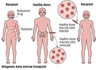 Allogeneic Bone Marrow Transplant