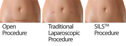 laparoscopic hysterectomy before and after