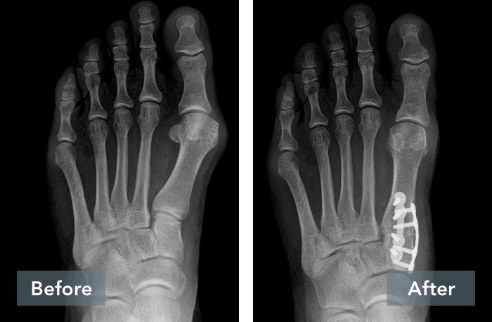 Results of Lapiplasty surgery on left foot