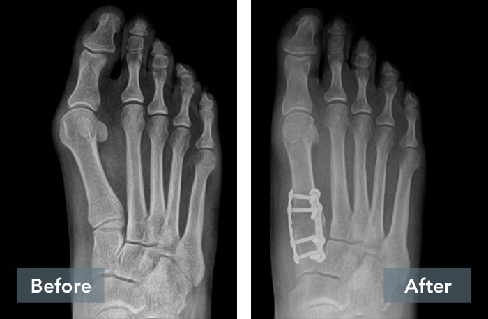 Results of Lapiplasty surgery on right foot